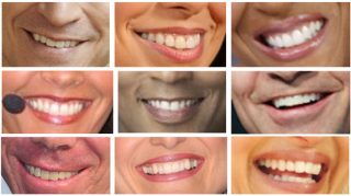 Illustration for article titled Girls Are More Likely Than Boys to Hate Their Teeth and Want Braces